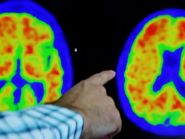 Donanemab found to slow Alzheimer’s and hailed a ‘turning point in fight against disease’ | Science & Tech News