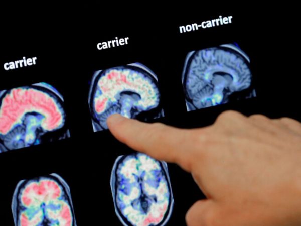 New Alzheimer’s drugs offer hope for bleak diagnosis but remain out of reach in UK | Science & Tech News