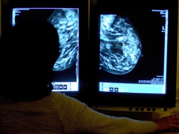 AI tools can ‘safely’ read breast cancer scans, preliminary study suggests | Science & Tech News