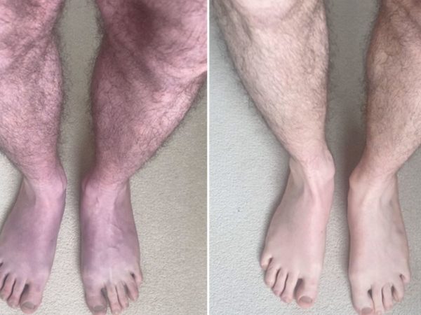 Long COVID: Unusual case turns man’s legs blue after 10 minutes of standing up | Science & Tech News