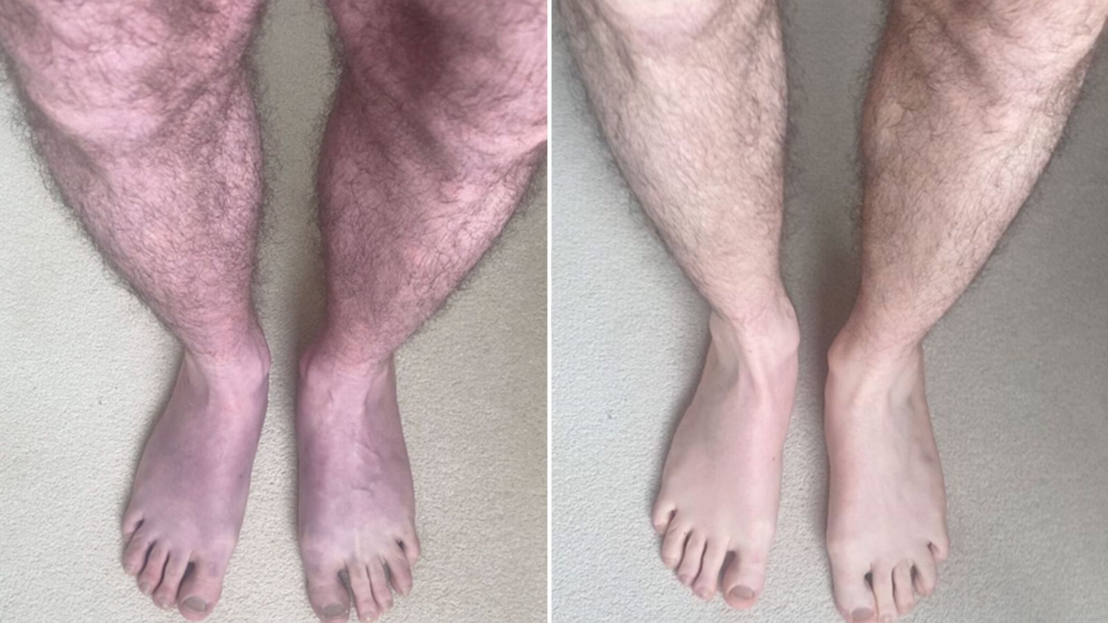 Long COVID: Unusual case turns man’s legs blue after 10 minutes of standing up | Science & Tech News