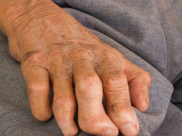 Leprosy is on the rise in the US and could be endemic in Florida, report says | US News